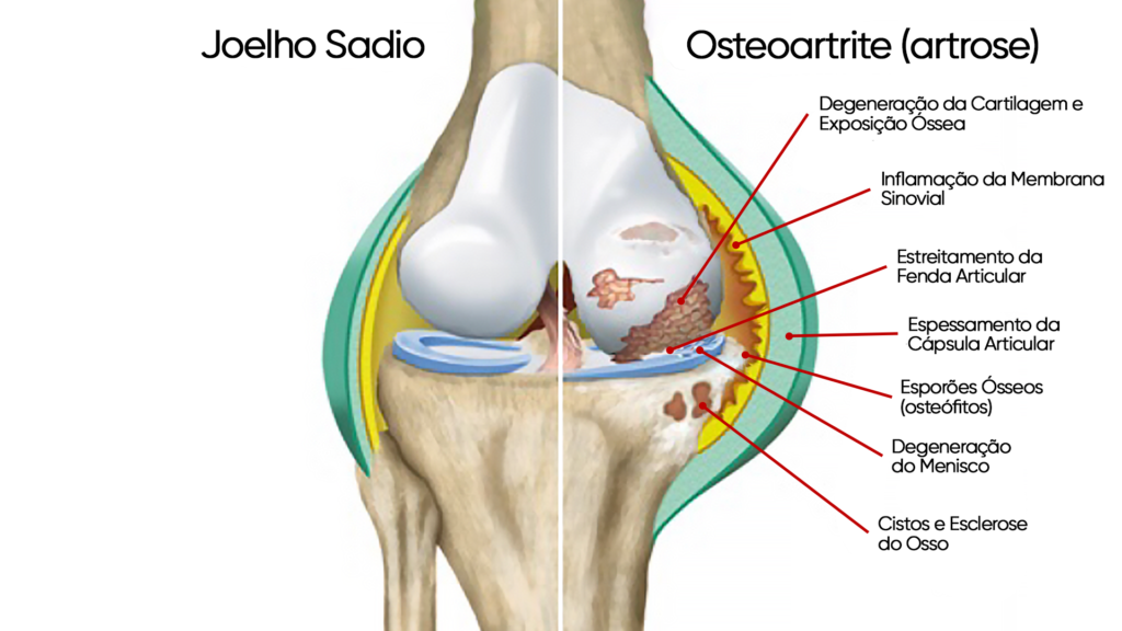 Imagem comparativa, joelho sadio e Osteoartrite (artrose)