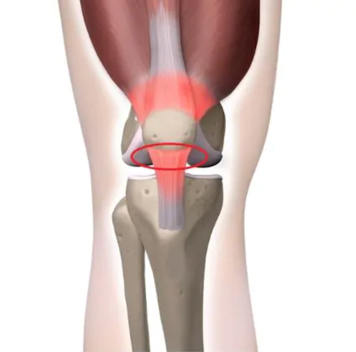 Tendinite Patelar